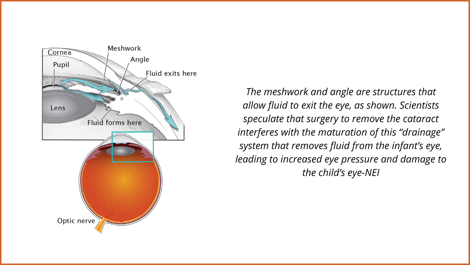 Cataract Surgery In Infancy Increases Glaucoma Risk - Eyezone International