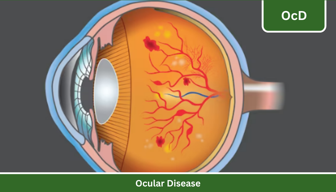 Read more about the article Diabetic Eye Disease – Part 1